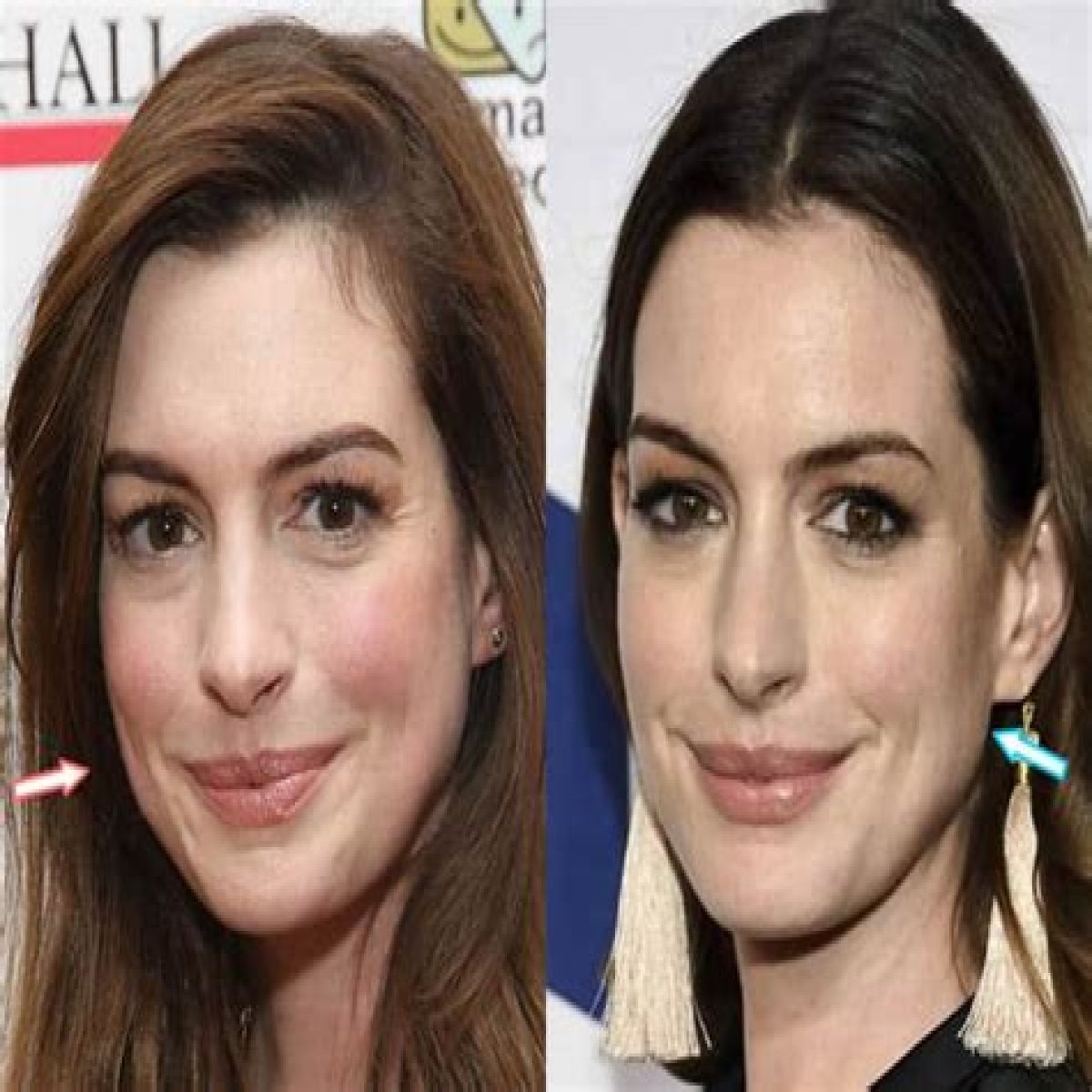 Anne Hathaway’s Plastic Surgery In 2 Rhinoplasty, Boob Job, & Botox Injection Rumors Examined!